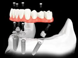 Полная тотальная имплантация